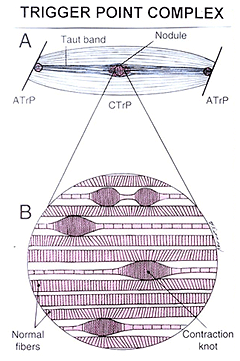 Trigger Point Therapy - Treating Pectoralis Major