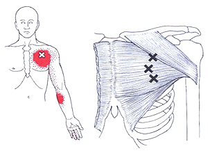 Trigger Point Therapy - Treating Pectoralis Major, Pectoralis Muscles,  Shoulder and more